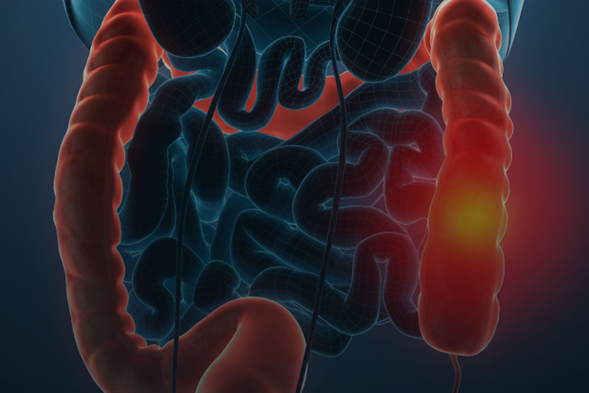 câncer de intestino