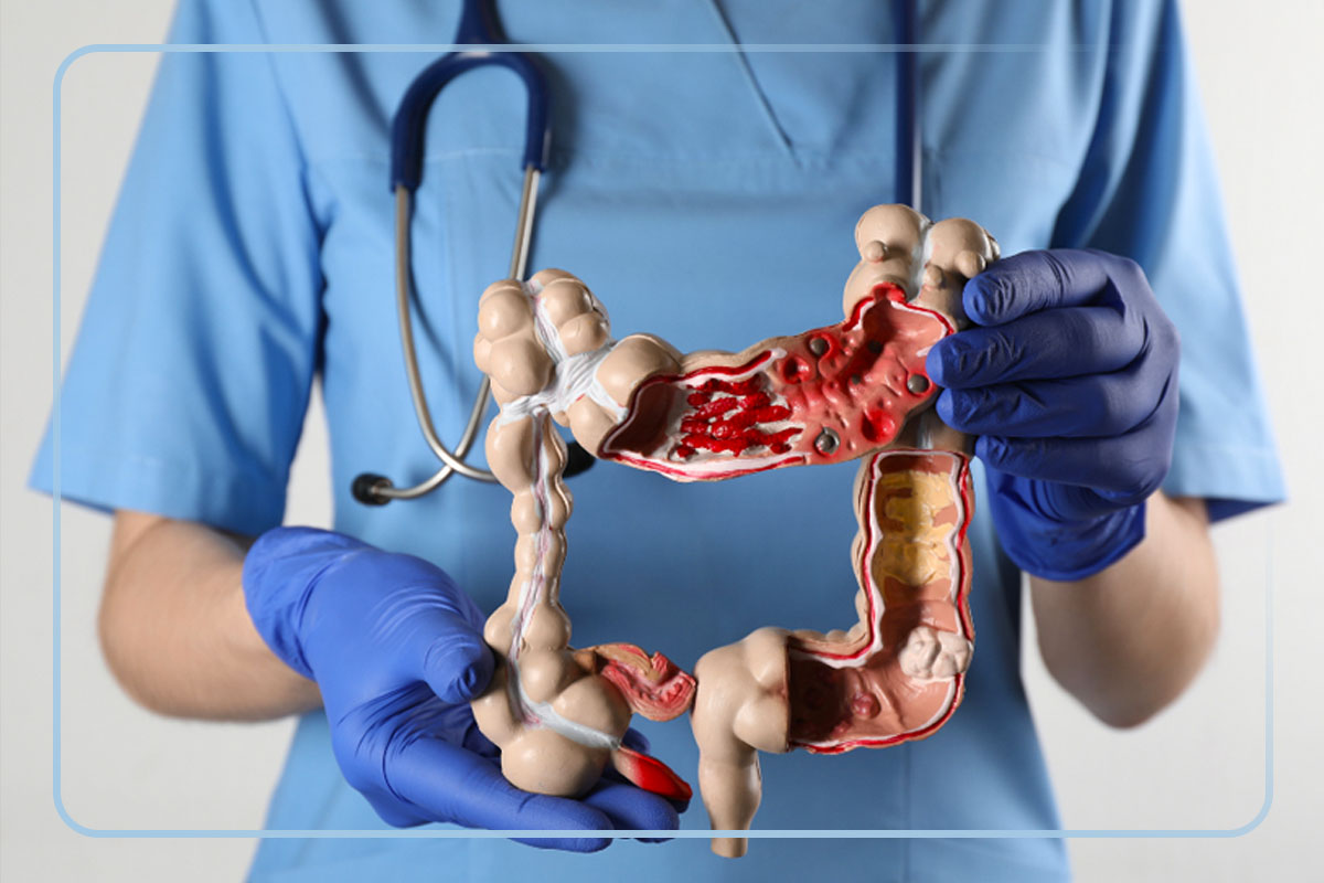 câncer de intestino