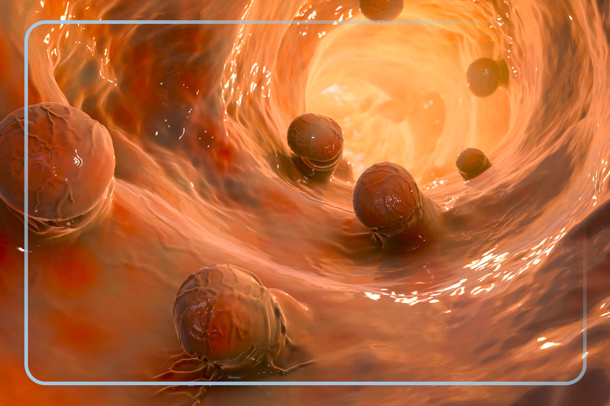 câncer de intestino