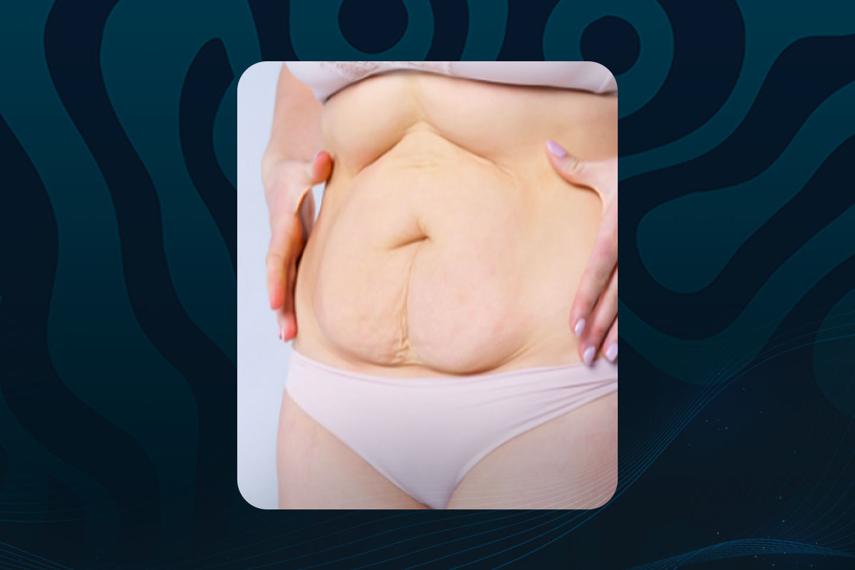 diástase abdominal; pós-parto